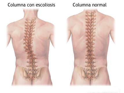 ESCOLIOSIS