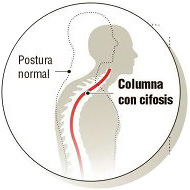Curvatura normal de la espalda comparada con curva cifosis - cuidatuespalda